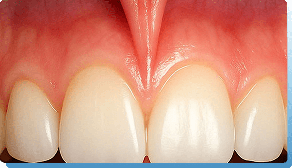 Frenulektomija Dental centar Djuric Novi Sad