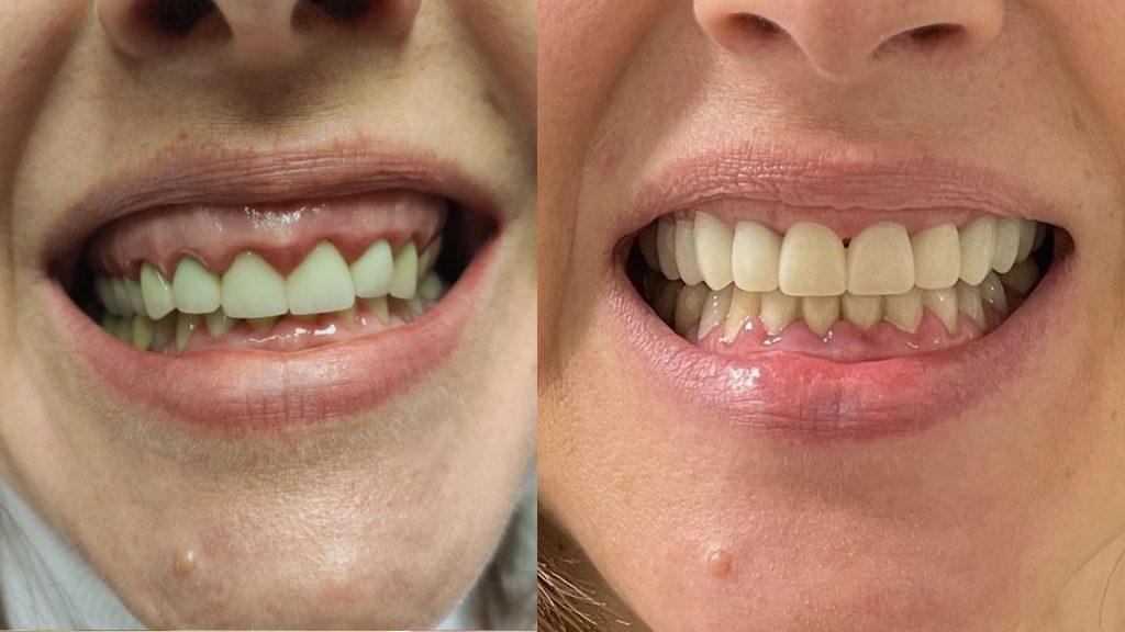 Gingivektomija u Dental centru Djuric Novi Sad