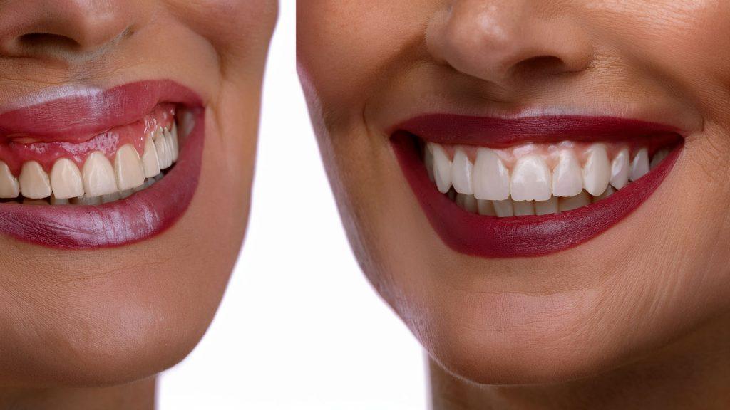 Primer ilustracija Gummy Smile i gingiva