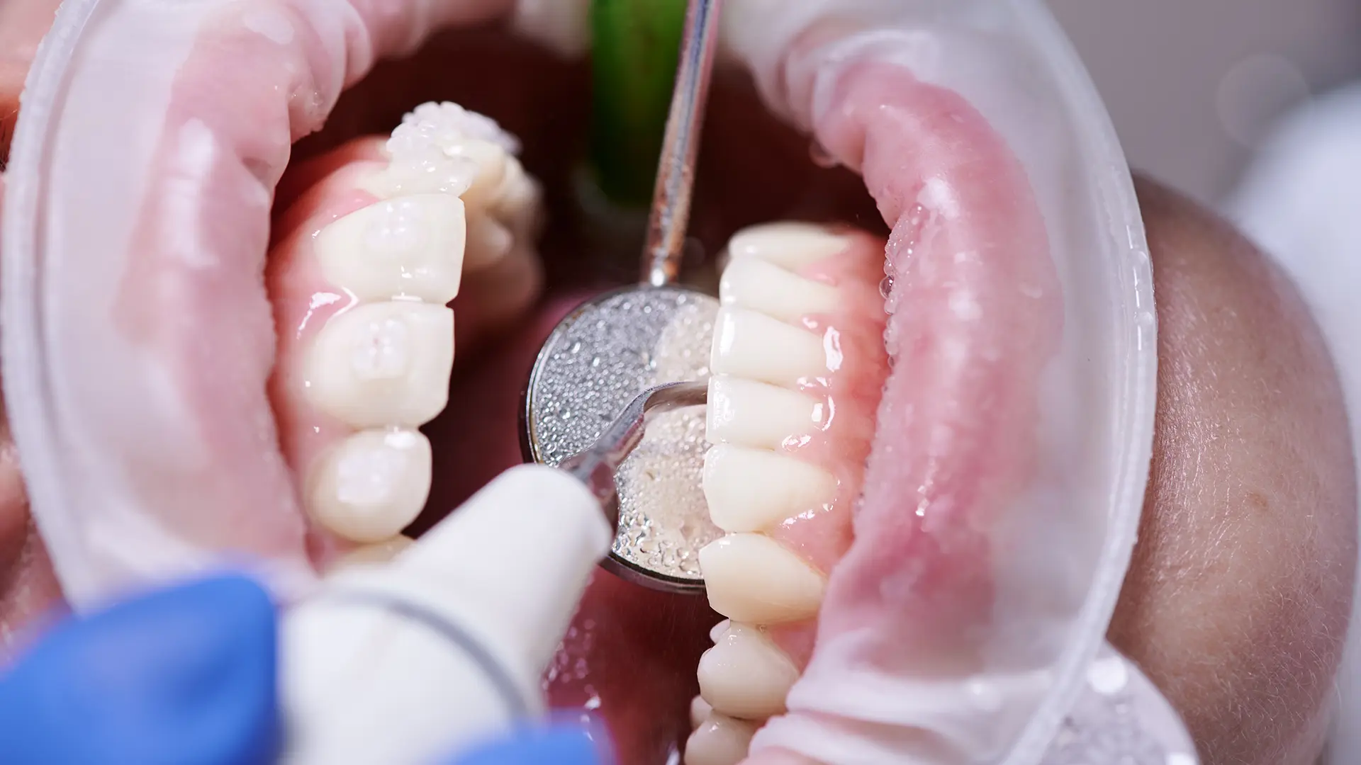 Povlacenje desni uzroci i lecenje