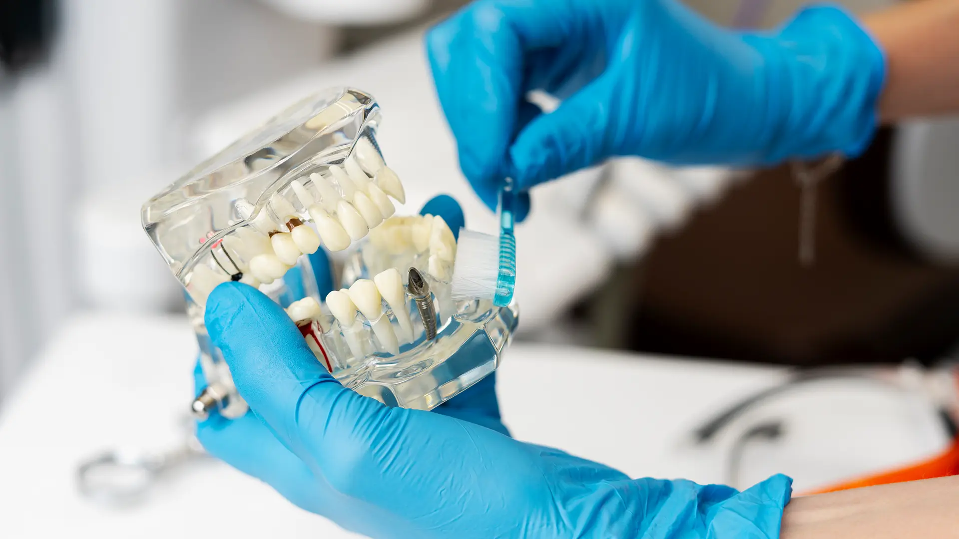 ODrzavanje dentalnih implanata