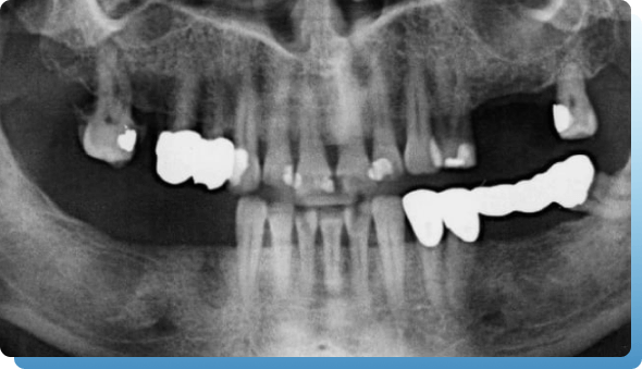 dentina implantologija slika 1