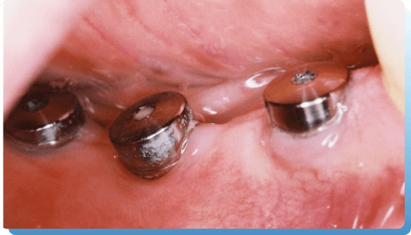 dentina implantologija slika 2