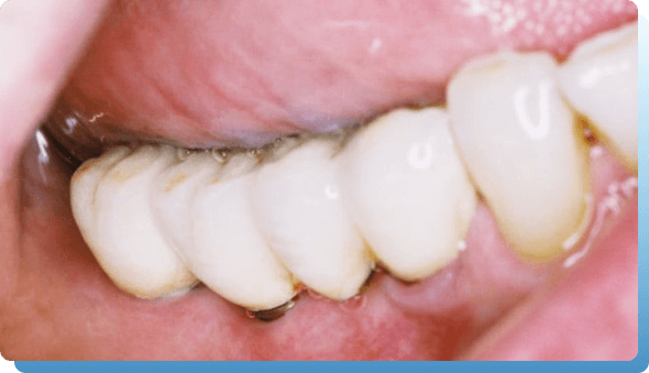 dentina implantologija slika 3