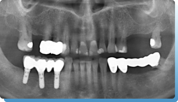 dentina implantologija slika 4