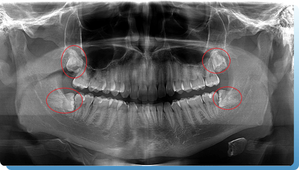 dentina oralna hirurgija slika 2