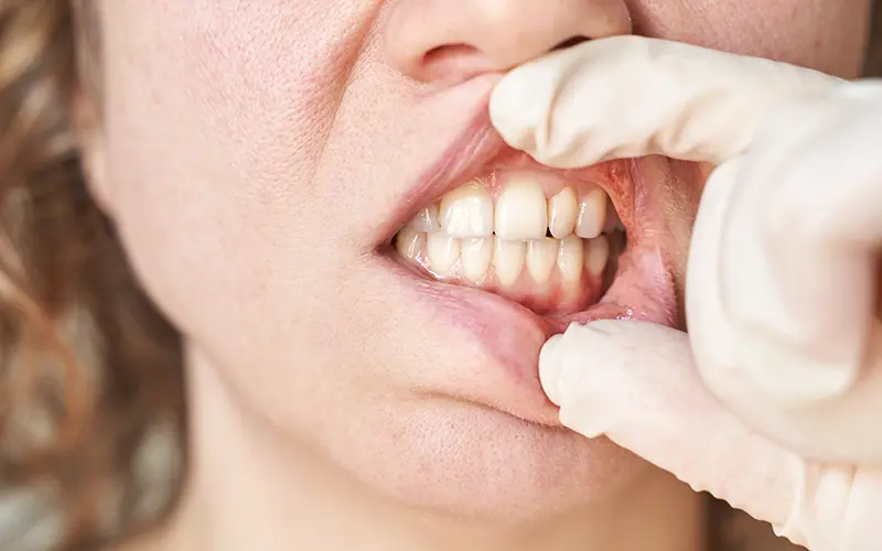 Paradontalni dzepovi Dentina Novi sad