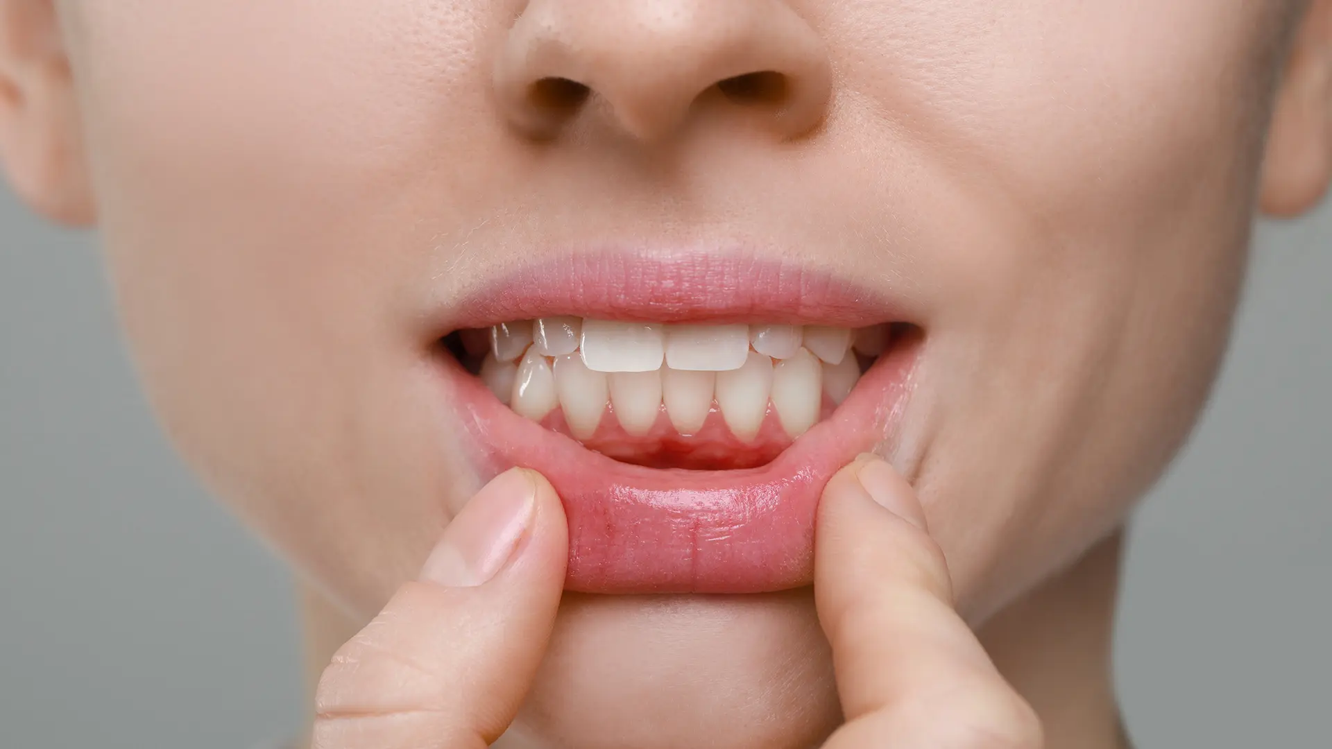 Gingivitis Upala desni