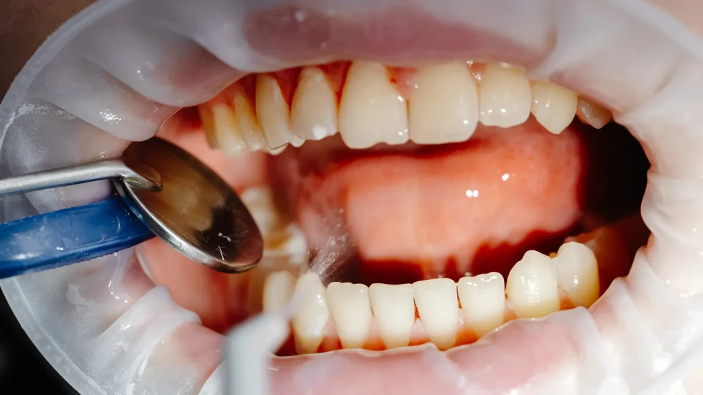 Gingivitis pregled i lecenenje Dentina Novi sad