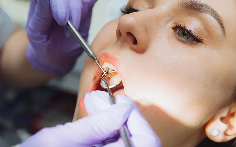 Kako nastaje zubni plak Ordinacija Dentina Novi Sad