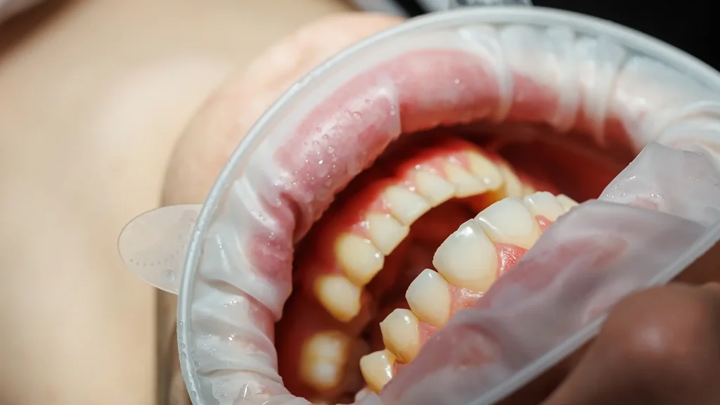 Lecenje upale desni Dentina Novi Sad